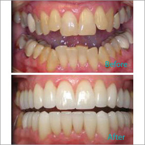 Full Mouth Reconstruction Treatment