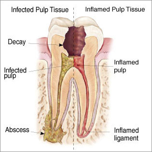 Dental Root Canal Treatment
