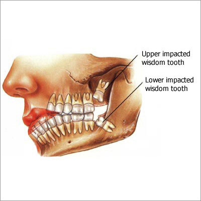 Wisdom Tooth Treatment
