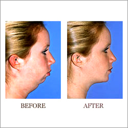 Jaw Surgery