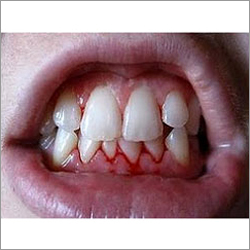 Gums Treatment