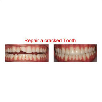 Cracked Tooth Restoration