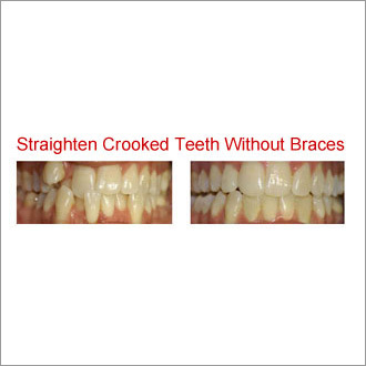 Cosmetic Teeth Whitening