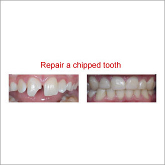 Porcelain Filling Service