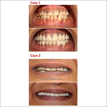 Full Mouth Rehabilitation