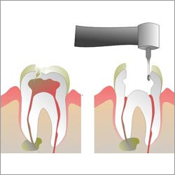 Root Canal Treatment