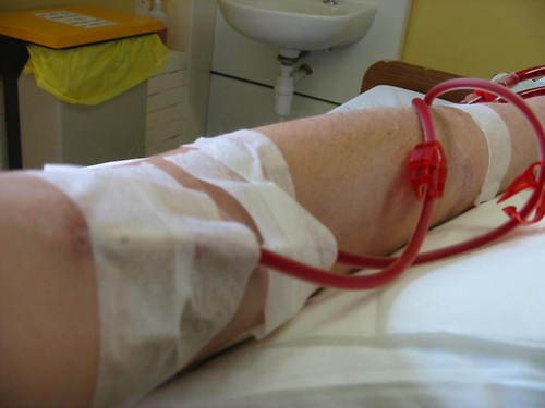 Hemodialysis Blood Tubing Sets By ALAN MEDICAL