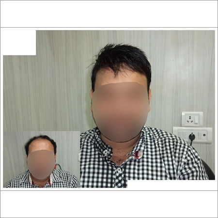 Best Hair Weaving In Delhi Fusion Hair Transplant T 136 5 Abc