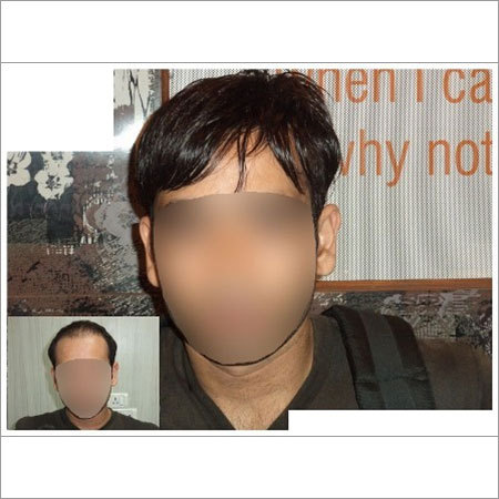 Hair Weaving Cost In Delhi Fusion Hair Transplant T 136 5 Abc