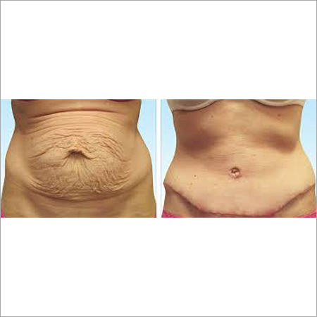 Abdominoplasty Cosmetic Surgery