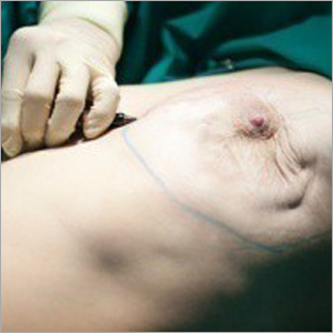 Breast Cancer Treatment
