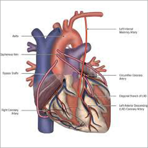 Cardiac Bypass Surgery