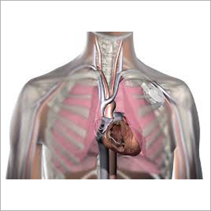 Pacemaker Implantation