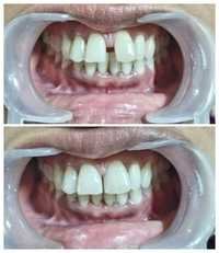 Cosmetic Dentistry Before & After Pictures 