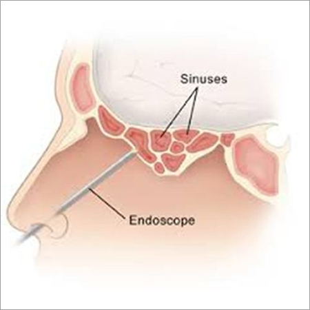 Endoscopic Sinus Surgery
