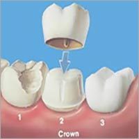 Dental Caps