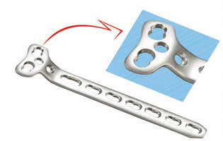 Locking T Buttress Plates