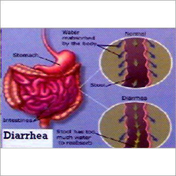 Diarrhea