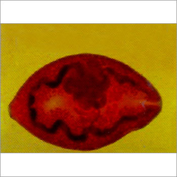 Paragonimiasis