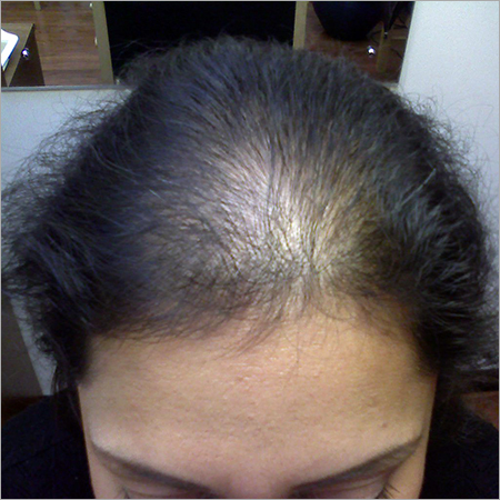 Homeopathic Women Hair Loss Treatment