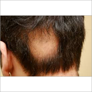 Alopecia Areata Homeopathic Treatment