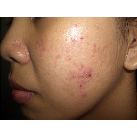 Homeopathic Acne Treatment 