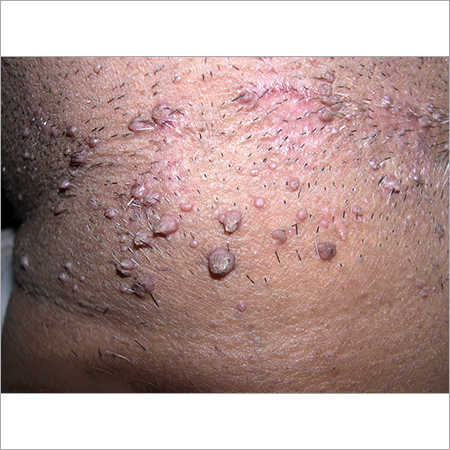Homeopathic Warts Treatment