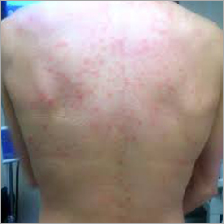 Chronic Urticaria Homeopathic Treatment