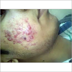 Homeopathy Pimples Treatment