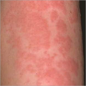 Homeopathic Urticaria Treatment