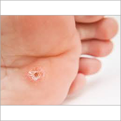 Homeopathy Corns Treatment 