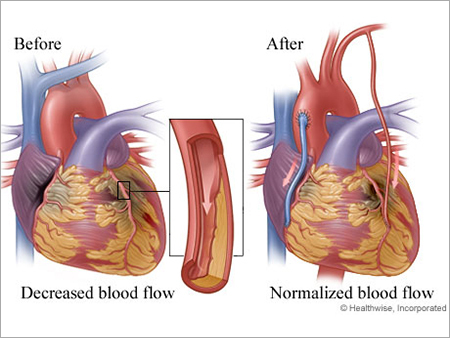 Bypass Surgery Services