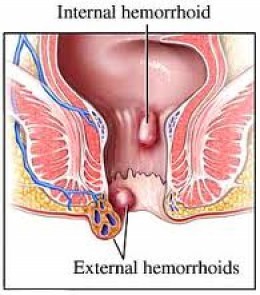 Homeopathic Piles Treatment