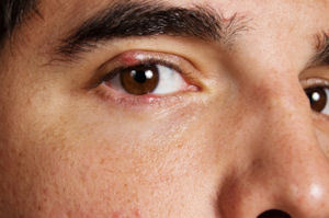 Stye Homeopathic Treatment