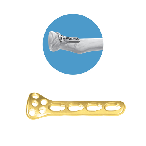 Locking Proximal Radial Head Neck Plate