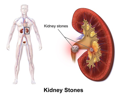 Homeopathic Kidney Stones Treatment
