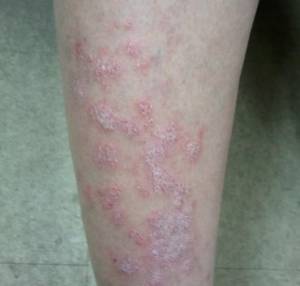HOMEOPATHIC ECZEMA TREATMENT