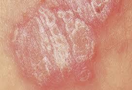 PSORIASIS TREATMENT