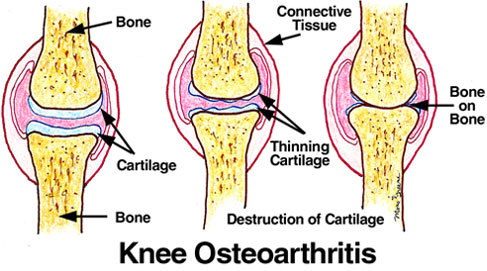 Osteoarthritis Homeopathic Treatment 