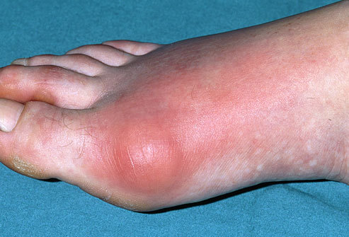 HOMEOPATHIC RHEUMATOID GOUT TREATMENT By AASHIRWAD HOMEOPATHIC CLINIC
