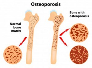 Osteoporosis Homeopathic Treatment