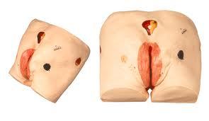 Decubitus Ulcer Care Model
