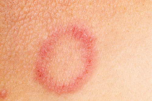 Homeopathy Ringworm Treatment