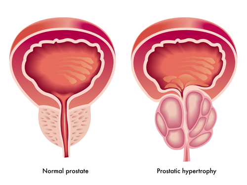 Homeopathic Prostate Problems Treatment
