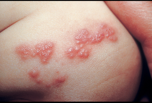 Homeopathic Herpes Zoster Treatment