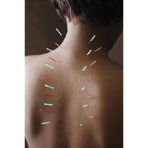ACP Acupuncture Needle Tube Pck. 100pc 1