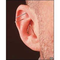 Acupuncture Ear Needle-Press Needle 100pc. .22x1.5