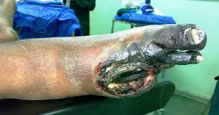 DIABETIC ULCER AND GANGRENE