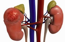 Kidney Ailment