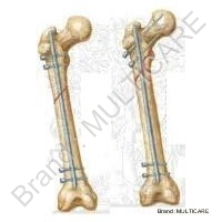 Tibia Femur & Expart Nail